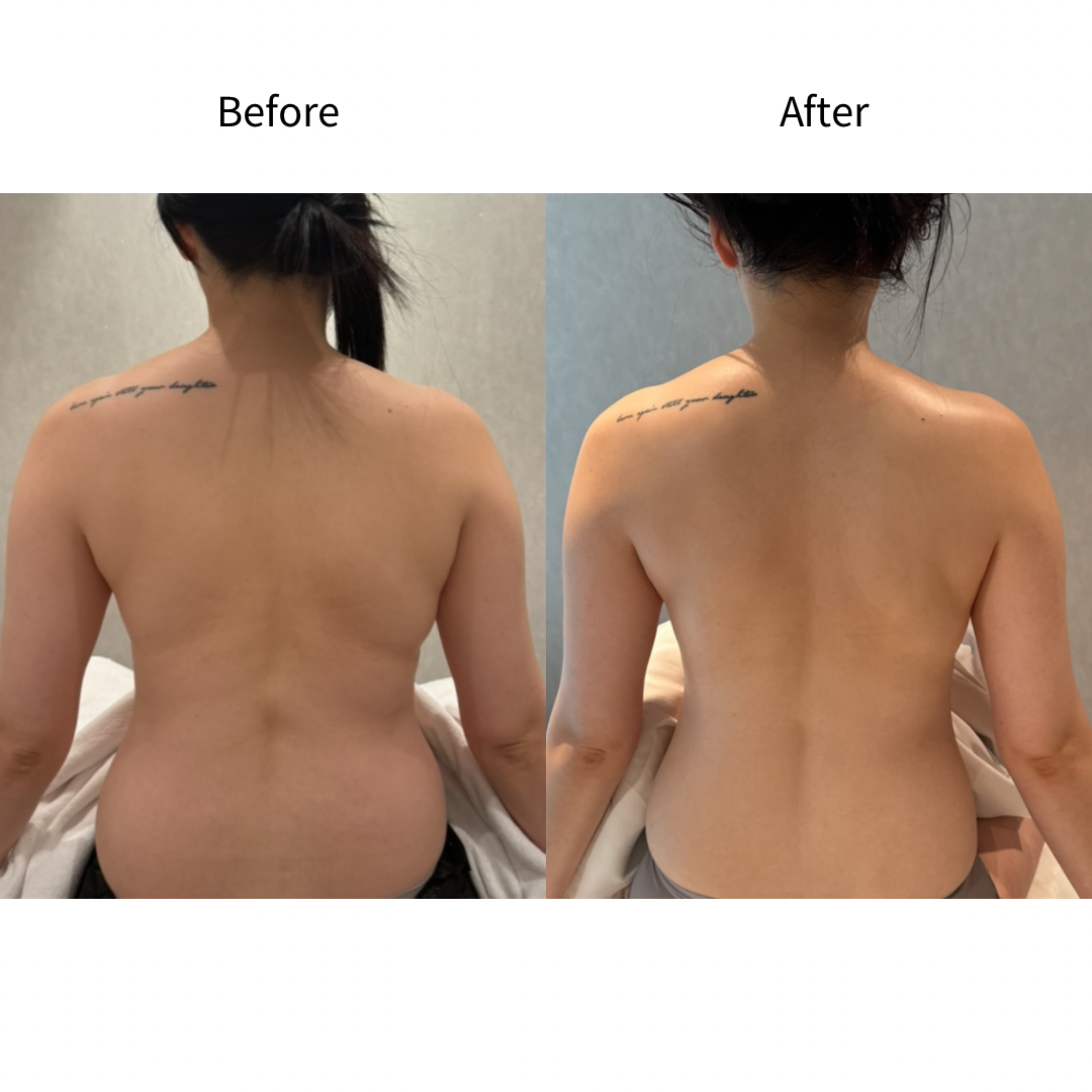 副乳·背部纤体