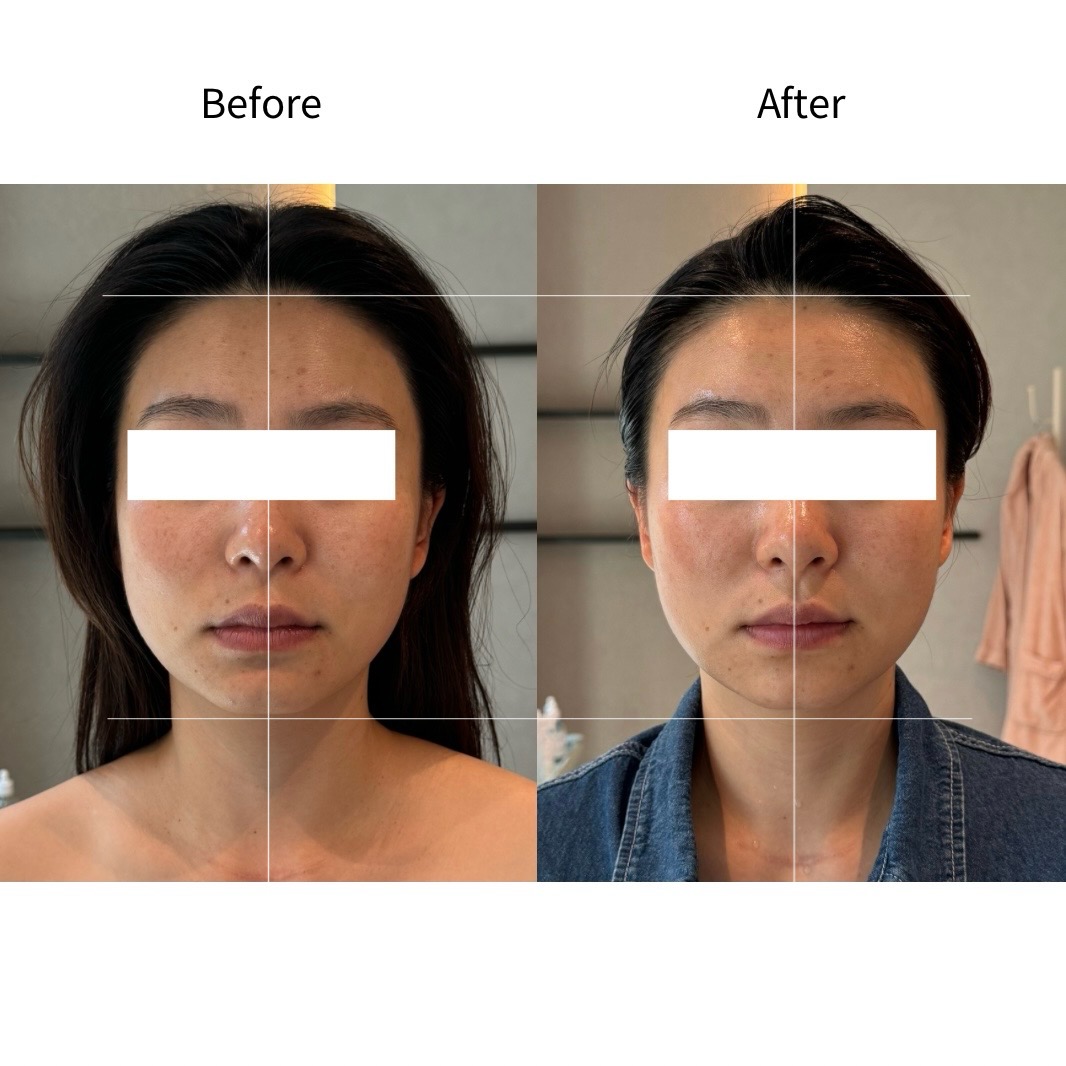 面部缩小·方下巴