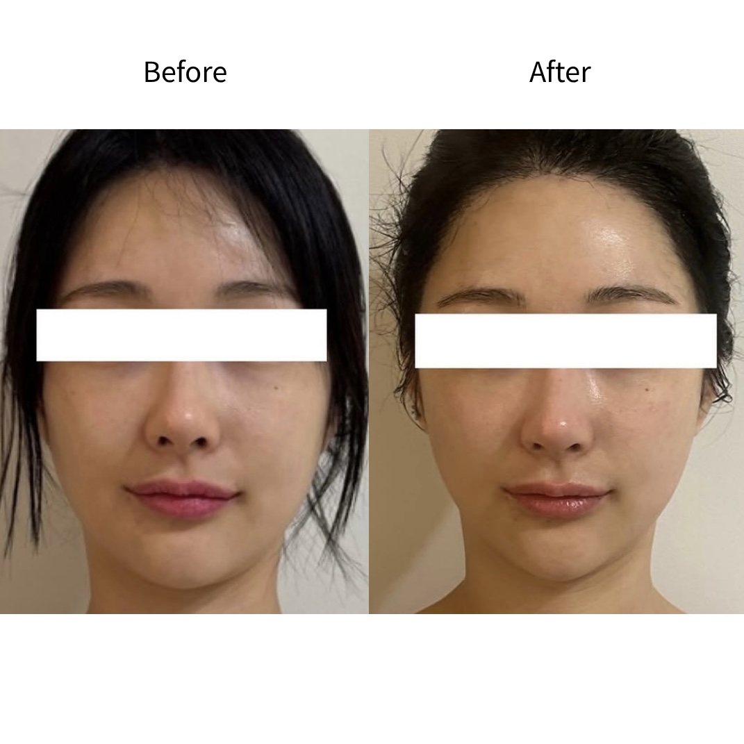 面部浮肿·对称均衡